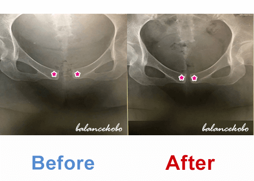 恥骨結合レントゲン写真